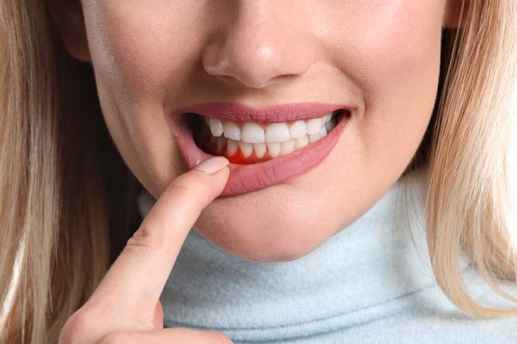 Ausschnitt des Gesichts einer Frau, die mit einem Finger die Unterlippe etwas runter zieht und ein gerötetes Zahnfleisch offenlegt. 