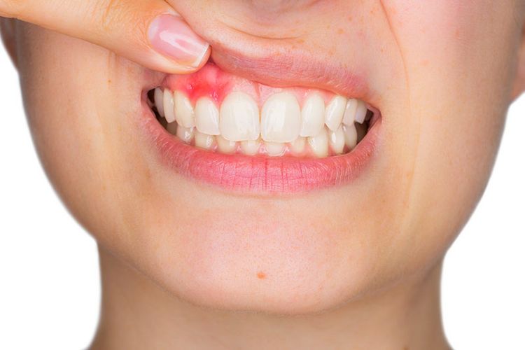 Eine Frau zieht mit ihrem Finger ihre Oberlippe hoch und zeigt eine entzündete Stelle des Zahnfleisches.