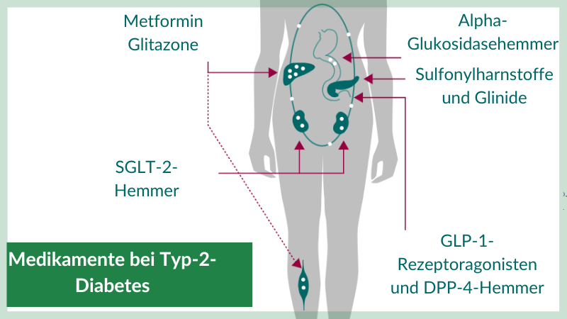 Die verschiedenen Wirkstoffe gegen Typ-2-Diabetes sind visuell am Wirkort eines Körpers abgebildet